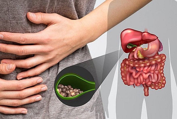 Sỏi mật chữa thế nào?