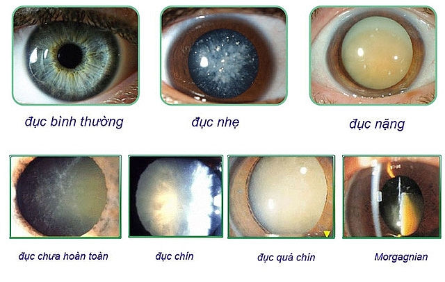Phân loại đục thủy tinh thể