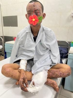 Cháy sém toàn thân, mất thị lực do dùng điện thoại khi đang sạc