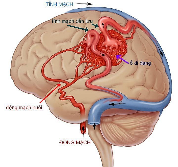 Dị dạng động mạch-tĩnh mạch