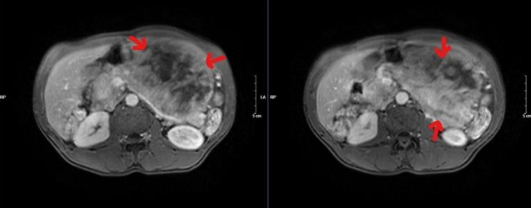 GIST dạ dày - Căn bệnh lành tính để muộn thành ung thư
