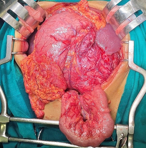 GIST dạ dày - Căn bệnh lành tính để muộn thành ung thư