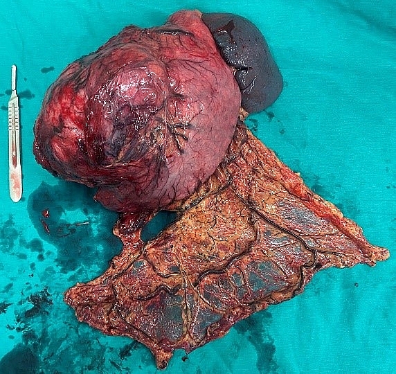 GIST dạ dày - Căn bệnh lành tính để muộn thành ung thư