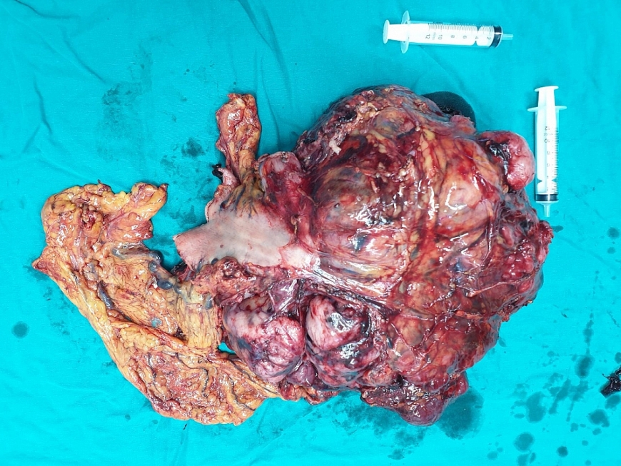 GIST dạ dày - Căn bệnh lành tính để muộn thành ung thư