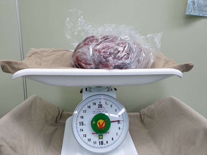 GIST dạ dày - Căn bệnh lành tính để muộn thành ung thư