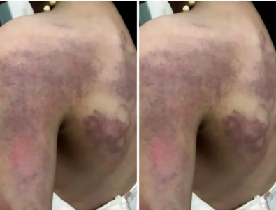 Tạm đình chỉ công việc đối với cô giáo đánh học sinh lớp 3 bầm tím lưng
