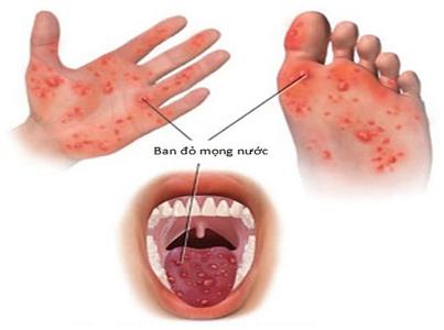 Dấu hiệu nhận biết trẻ mắc tay chân miệng