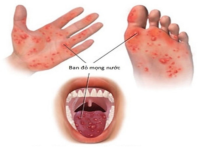 Dấu hiệu nhận biết trẻ mắc tay chân miệng