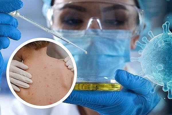 Việt Nam giám sát người đến từ 12 quốc gia lưu hành ca bệnh đậu mùa khỉ