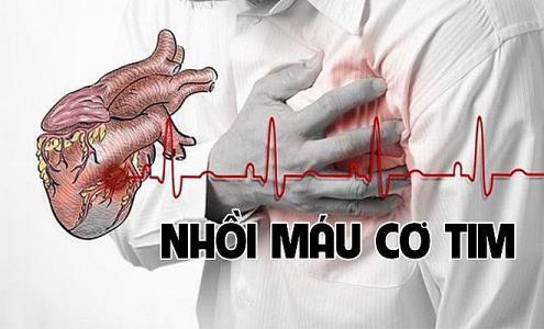 Cấp cứu thành công nam thanh niên 26 tuổi bị nhồi máu cơ tim sau bữa rượu