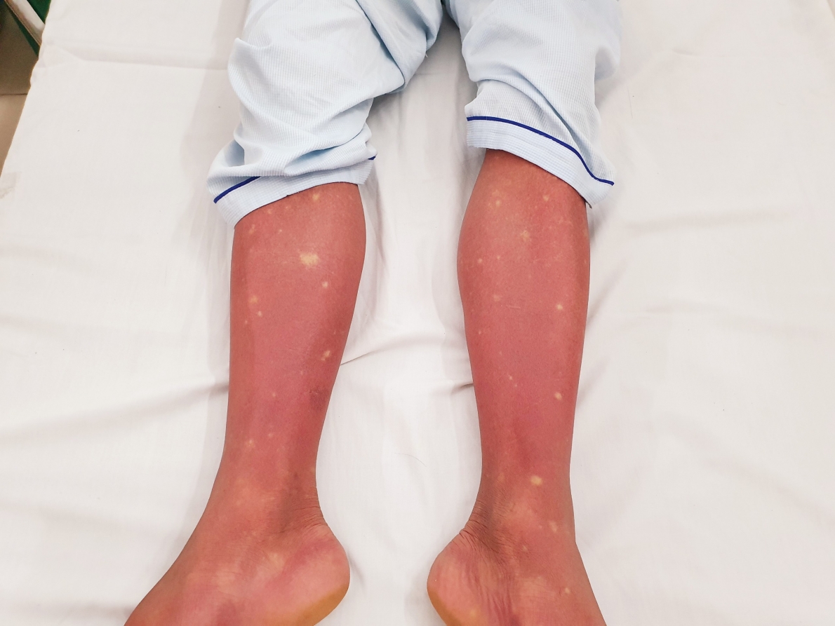 Cảnh giác bùng phát dịch sốt xuất huyết Dengue ở Miền Bắc