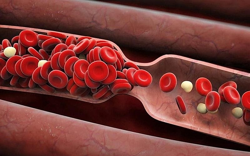 Dùng thuốc điều trị mỡ máu cao, cần lưu ý gì?