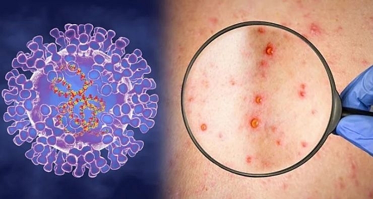 Bộ Y tế ban hành Hướng dẫn chẩn đoán, điều trị và phòng bệnh đậu mùa khỉ ở người
