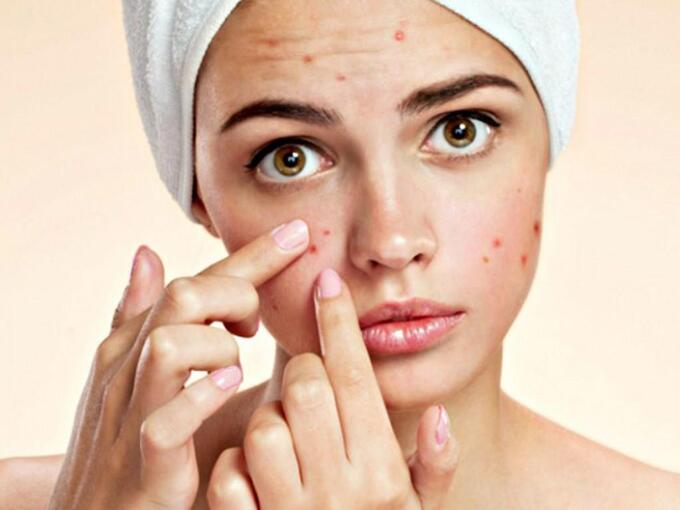 Các bài thuốc đông y trị mụn trứng cá