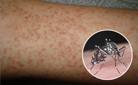 Hà Nội ghi nhận thêm 72 ổ dịch và 2 ca tử vong vì sốt xuất huyết