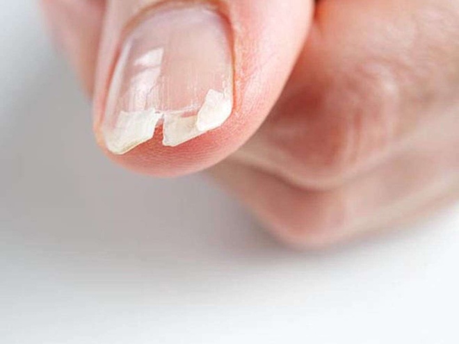 5 dấu hiệu sớm để xác định tình trạng thiếu sắt trên da, tóc và móng tay