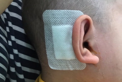 Phẫu thuật cấy ốc tai giúp trẻ vừa điếc bẩm sinh vừa bị máu khó đông nghe được