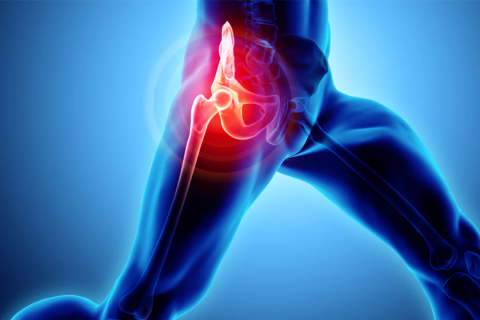 Điều trị đau giúp giảm di chứng ở người thay khớp háng