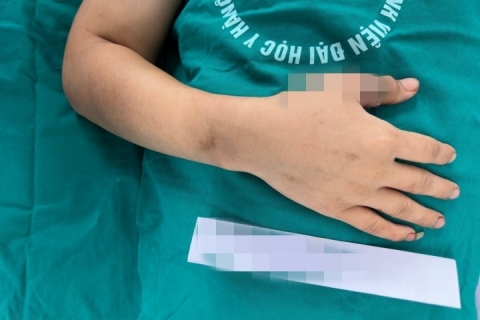 Phẫu thuật nối chi cho bé 9 tuổi bị dập nát tay do nghịch máy giặt